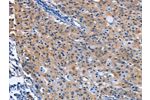The image on the left is immunohistochemistry of paraffin-embedded Human gastic cancer tissue using CSB-PA438445(CDO1 Antibody) at dilution 1/40, on the right is treated with fusion protein. (Original magnification: 