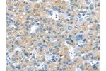 The image on the left is immunohistochemistry of paraffin-embedded Human liver cancer tissue using CSB-PA438768(ERP44 Antibody) at dilution 1/20, on the right is treated with synthetic peptide. (Original magnification: 