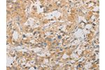 The image on the left is immunohistochemistry of paraffin-embedded Human thyroid cancer tissue using CSB-PA438801(ARSG Antibody) at dilution 1/30, on the right is treated with fusion protein. (Original magnification: 