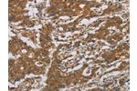 The image is immunohistochemistry of paraffin-embedded Human gastic cancer tissue using CSB-PA439589(CNDP1 Antibody) at dilution 1/30. (Original magnification: 