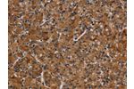 The image on the left is immunohistochemistry of paraffin-embedded Human prostate cancer tissue using CSB-PA439630(CYP1A2 Antibody) at dilution 1/40, on the right is treated with synthetic peptide. (Original magnification: 