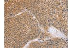 The image on the left is immunohistochemistry of paraffin-embedded Human liver cancer tissue using CSB-PA439979(BRS3 Antibody) at dilution 1/50, on the right is treated with synthetic peptide. (Original magnification: 