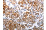 The image on the left is immunohistochemistry of paraffin-embedded Human liver cancer tissue using CSB-PA440133(CDH5 Antibody) at dilution 1/40, on the right is treated with synthetic peptide. (Original magnification: 