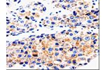 The image on the left is immunohistochemistry of paraffin-embedded Human liver cancer tissue using CSB-PA440339(ABCG2 Antibody) at dilution 1/50, on the right is treated with synthetic peptide. (Original magnification: 