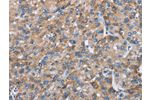 The image on the left is immunohistochemistry of paraffin-embedded Human liver cancer tissue using CSB-PA440550(CHDH Antibody) at dilution 1/25, on the right is treated with fusion protein. (Original magnification: 