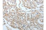 The image on the left is immunohistochemistry of paraffin-embedded Human ovarian cancer tissue using CSB-PA440612(CRMP1 Antibody) at dilution 1/20, on the right is treated with fusion protein. (Original magnification: 