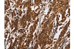 The image on the left is immunohistochemistry of paraffin-embedded Human gastic cancer tissue using CSB-PA440750(CTAG1A/B Antibody) at dilution 1/25, on the right is treated with synthetic peptide. (Original magnification: 