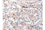 The image on the left is immunohistochemistry of paraffin-embedded Human lung cancer tissue using CSB-PA440881(CDK7 Antibody) at dilution 1/30, on the right is treated with fusion protein. (Original magnification: 