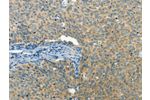 The image on the left is immunohistochemistry of paraffin-embedded Human cervical cancer tissue using CSB-PA440945(BCAT1 Antibody) at dilution 1/50, on the right is treated with fusion protein. (Original magnification: 