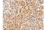 The image on the left is immunohistochemistry of paraffin-embedded Human esophagus cancer tissue using CSB-PA441788(ANXA8 Antibody) at dilution 1/35, on the right is treated with fusion protein. (Original magnification: 