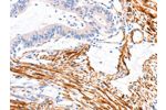 The image on the left is immunohistochemistry of paraffin-embedded Human colon cancer tissue using CSB-PA442774(ARAP1 Antibody) at dilution 1/80, on the right is treated with synthetic peptide. (Original magnification: 