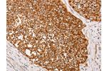 The image on the left is immunohistochemistry of paraffin-embedded Human cervical cancer tissue using CSB-PA443063(AK2 Antibody) at dilution 1/40, on the right is treated with fusion protein. (Original magnification: 