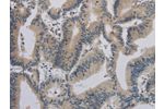 The image on the left is immunohistochemistry of paraffin-embedded Human colon cancer tissue using CSB-PA443536(ACVR1B Antibody) at dilution 1/30, on the right is treated with synthetic peptide. (Original magnification: 