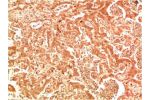 Immunohistochemical analysis of paraffin-embedded Human Hepatocarcinoma Tissue using ATG7 Rabbit pAb diluted at 1:200