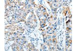 The image on the left is immunohistochemistry of paraffin-embedded Human breast cancer tissue using CSB-PA443866(AGA Antibody) at dilution 1/20, on the right is treated with fusion protein. (Original magnification: 