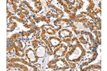 The image on the left is immunohistochemistry of paraffin-embedded Human thyroid cancer tissue using CSB-PA444394(AIFM3 Antibody) at dilution 1/40, on the right is treated with fusion protein. (Original magnification: 