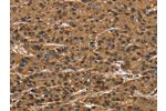 The image on the left is immunohistochemistry of paraffin-embedded Human liver cancer tissue using CSB-PA444799(ATP7A  Antibody) at dilution 1/50, on the right is treated with synthetic peptide. (Original magnification: 