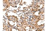 The image on the left is immunohistochemistry of paraffin-embedded Human thyroid cancer tissue using CSB-PA444901(CUL4B Antibody) at dilution 1/50, on the right is treated with synthetic peptide. (Original magnification: 