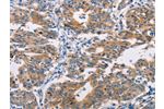 The image on the left is immunohistochemistry of paraffin-embedded Human gastic cancer tissue using CSB-PA445497(AGPAT4 Antibody) at dilution 1/25, on the right is treated with fusion protein. (Original magnification: 