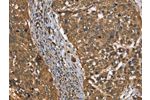 The image on the left is immunohistochemistry of paraffin-embedded Human cervical cancer tissue using CSB-PA445499(CSTB Antibody) at dilution 1/30, on the right is treated with synthetic peptide. (Original magnification: 