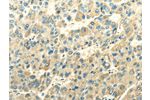 The image on the left is immunohistochemistry of paraffin-embedded Human liver cancer tissue using CSB-PA445587(DLAT Antibody) at dilution 1/30, on the right is treated with fusion protein. (Original magnification: 