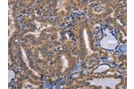 The image on the left is immunohistochemistry of paraffin-embedded Human thyroid cancer tissue using CSB-PA445679(CD47 Antibody) at dilution 1/50, on the right is treated with synthetic peptide. (Original magnification: 