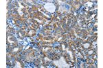 The image on the left is immunohistochemistry of paraffin-embedded Human thyroid cancer tissue using CSB-PA445711(AGL Antibody) at dilution 1/30, on the right is treated with synthetic peptide. (Original magnification: 