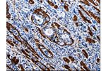 The image is immunohistochemistry of paraffin-embedded Human stomach cancer tissue using CSB-PA445794(ACE2 Antibody) at dilution 1/40. (Original magnification: 