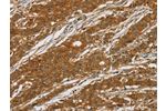 The image on the left is immunohistochemistry of paraffin-embedded Human gastic cancer tissue using CSB-PA446866(CYP27A1 Antibody) at dilution 1/50, on the right is treated with fusion protein. (Original magnification: 