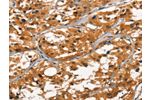The image on the left is immunohistochemistry of paraffin-embedded Human thyroid cancer tissue using CSB-PA446983(DEFA1/3 Antibody) at dilution 1/30, on the right is treated with synthetic peptide. (Original magnification: 