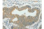 The image on the left is immunohistochemistry of paraffin-embedded Human colon cancer tissue using CSB-PA446984(CCND1 Antibody) at dilution 1/50, on the right is treated with fusion protein. (Original magnification: 