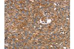 The image on the left is immunohistochemistry of paraffin-embedded Human breast cancer tissue using CSB-PA447195(ARMC10 Antibody) at dilution 1/30, on the right is treated with fusion protein. (Original magnification: 