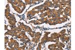 The image on the left is immunohistochemistry of paraffin-embedded Human breast cancer tissue using CSB-PA447308(DICER1 Antibody) at dilution 1/25, on the right is treated with synthetic peptide. (Original magnification: 