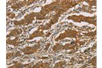 The image on the left is immunohistochemistry of paraffin-embedded Human gastic cancer tissue using CSB-PA447749(CYP39A1 Antibody) at dilution 1/50, on the right is treated with fusion protein. (Original magnification: 