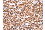The image on the left is immunohistochemistry of paraffin-embedded Human thyroid cancer tissue using CSB-PA447792(EMP2 Antibody) at dilution 1/30, on the right is treated with synthetic peptide. (Original magnification: 