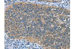The image on the left is immunohistochemistry of paraffin-embedded Human cervical cancer tissue using CSB-PA447859(DTX1 Antibody) at dilution 1/30, on the right is treated with synthetic peptide. (Original magnification: 