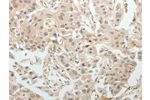 The image on the left is immunohistochemistry of paraffin-embedded Human ovarian cancer tissue using CSB-PA447968(ABCB11 Antibody) at dilution 1/15, on the right is treated with synthetic peptide. (Original magnification: 