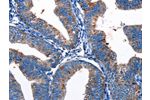 The image on the left is immunohistochemistry of paraffin-embedded Human cervical cancer tissue using CSB-PA448173(Gjc3 Antibody) at dilution 1/10, on the right is treated with synthetic peptide. (Original magnification: 