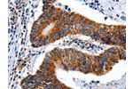 The image on the left is immunohistochemistry of paraffin-embedded Human colon cancer tissue using CSB-PA448237(ENPP3 Antibody) at dilution 1/15, on the right is treated with synthetic peptide. (Original magnification: 