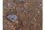 The image on the left is immunohistochemistry of paraffin-embedded Human cervical cancer tissue using CSB-PA449240(TLR2 Antibody) at dilution 1/50, on the right is treated with fusion protein. (Original magnification: 
