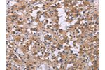 The image on the left is immunohistochemistry of paraffin-embedded Human thyroid cancer tissue using CSB-PA449267(FGFR2 Antibody) at dilution 1/20, on the right is treated with synthetic peptide. (Original magnification: 