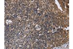 The image is immunohistochemistry of paraffin-embedded Human cervical cancer tissue using CSB-PA449695(GABPB2 Antibody) at dilution 1/30. (Original magnification: 