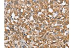 The image on the left is immunohistochemistry of paraffin-embedded Human thyroid cancer tissue using CSB-PA449858(CSMD1 Antibody) at dilution 1/40, on the right is treated with synthetic peptide. (Original magnification: 