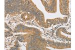 The image on the left is immunohistochemistry of paraffin-embedded Human colon cancer tissue using CSB-PA449930(ARHGAP15 Antibody) at dilution 1/30, on the right is treated with fusion protein. (Original magnification: 