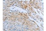 The image on the left is immunohistochemistry of paraffin-embedded Human esophagus cancer tissue using CSB-PA449957(FGF1 Antibody) at dilution 1/25, on the right is treated with synthetic peptide. (Original magnification: 