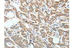 The image on the left is immunohistochemistry of paraffin-embedded Human breast cancer tissue using CSB-PA461581(AGR3 Antibody) at dilution 1/10, on the right is treated with fusion protein. (Original magnification: 