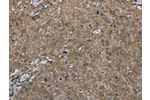 The image on the left is immunohistochemistry of paraffin-embedded Human esophagus cancer tissue using CSB-PA469305(CLPS Antibody) at dilution 1/45, on the right is treated with fusion protein. (Original magnification: 