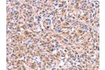The image on the left is immunohistochemistry of paraffin-embedded Human esophagus cancer tissue using CSB-PA477402(BMPR2 Antibody) at dilution 1/35, on the right is treated with fusion protein. (Original magnification: 
