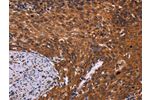 The image on the left is immunohistochemistry of paraffin-embedded Human cervical cancer tissue using CSB-PA478063(CDC5L Antibody) at dilution 1/40, on the right is treated with fusion protein. (Original magnification: 