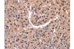 The image on the left is immunohistochemistry of paraffin-embedded Human liver cancer tissue using CSB-PA480274(EXTL1 Antibody) at dilution 1/20, on the right is treated with synthetic peptide. (Original magnification: 